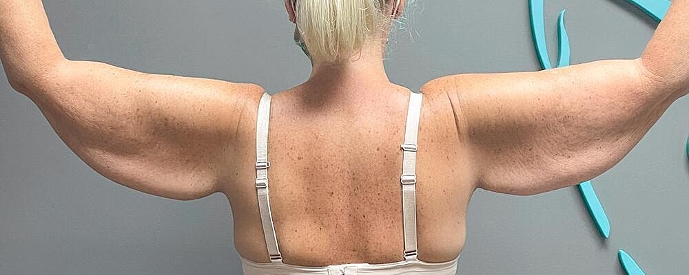 Arm Lift Before & After