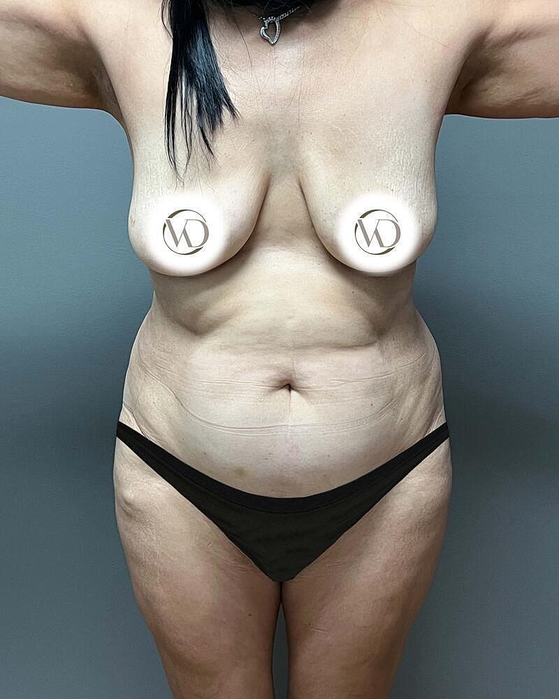 Tummy Tuck Before & After