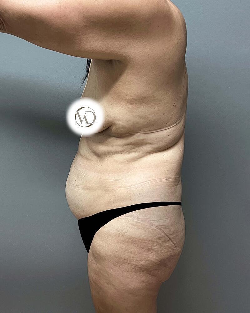 Tummy Tuck Before & After