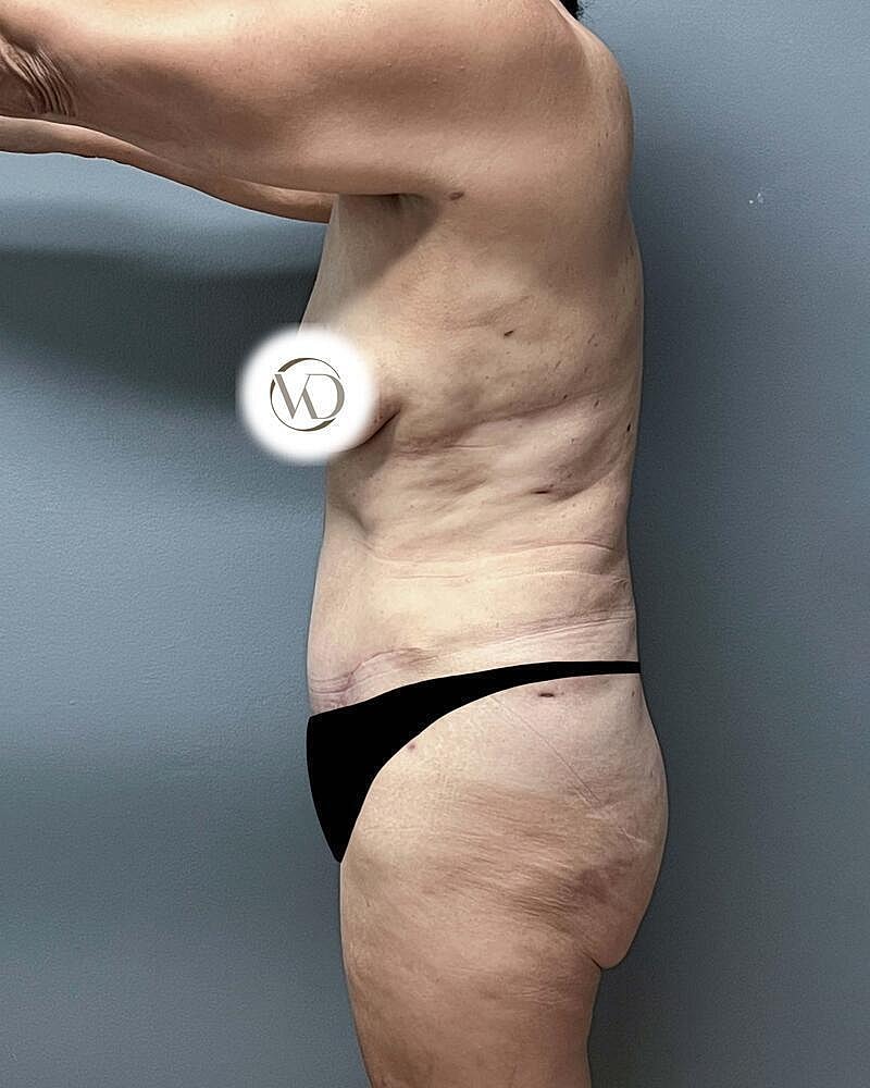 Tummy Tuck Before & After