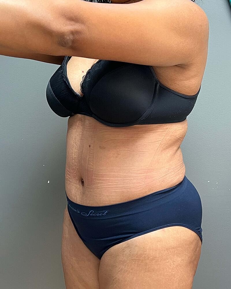 Tummy Tuck Before & After