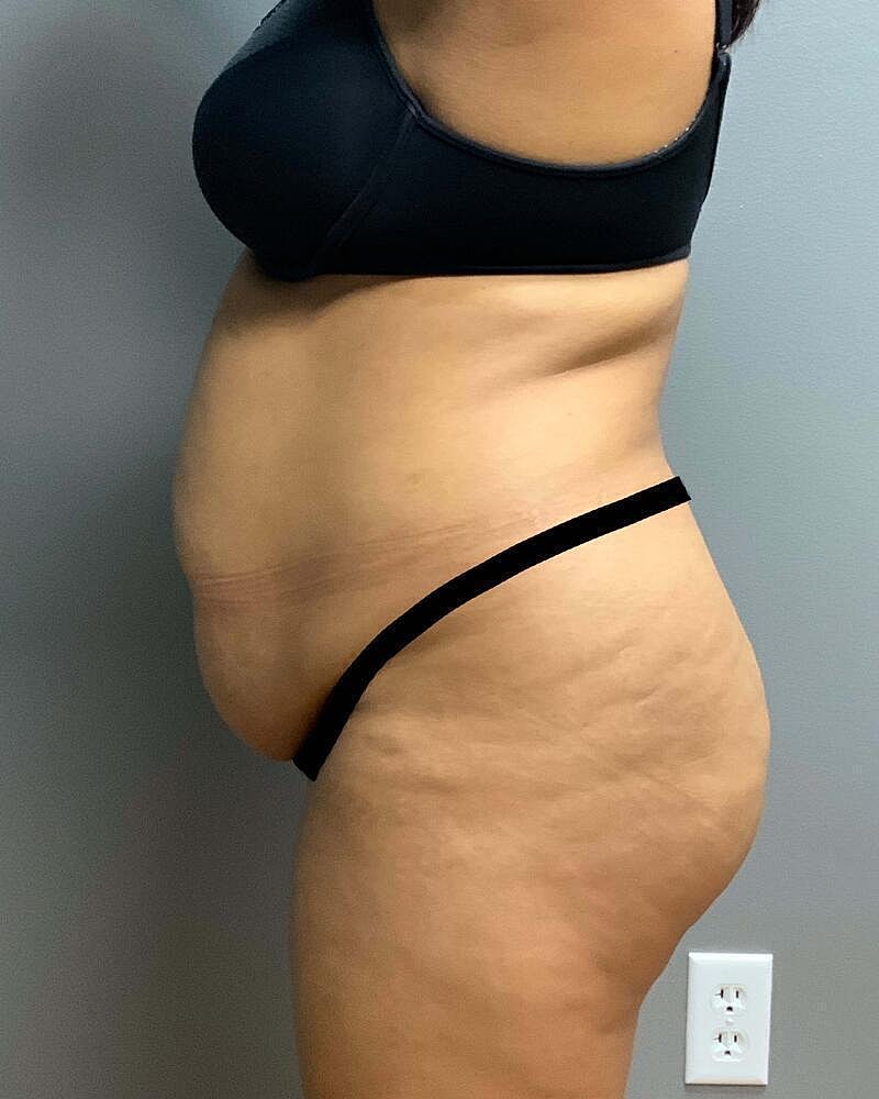 Tummy Tuck Before & After