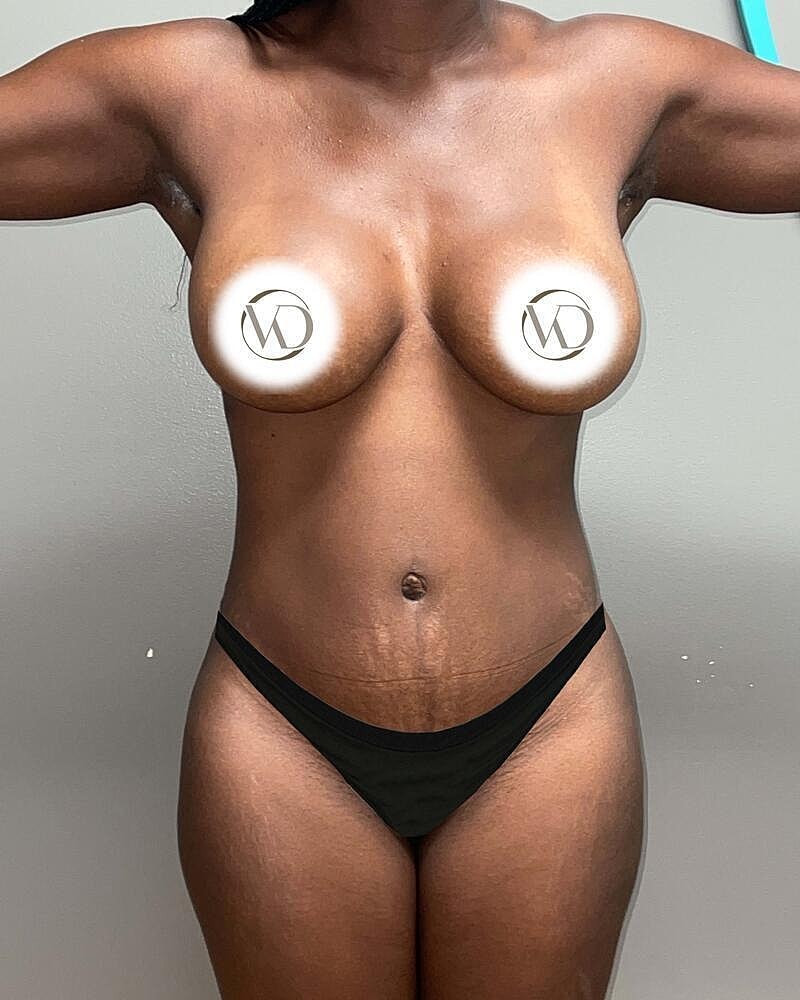 Tummy Tuck Before & After