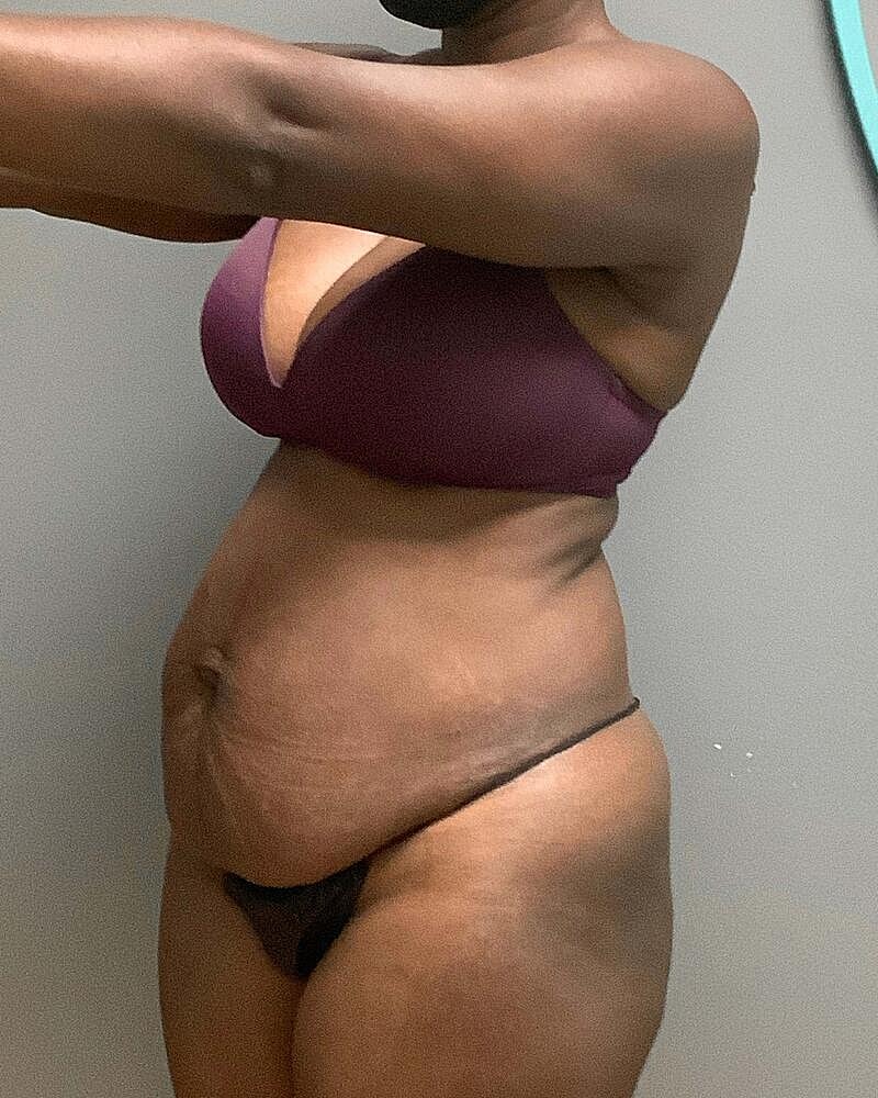 Tummy Tuck Before & After