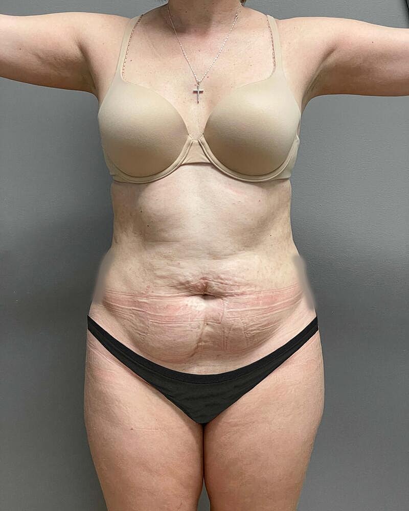 Tummy Tuck Before & After