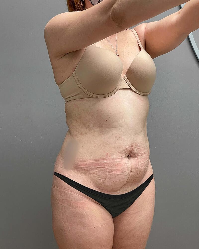 Tummy Tuck Before & After