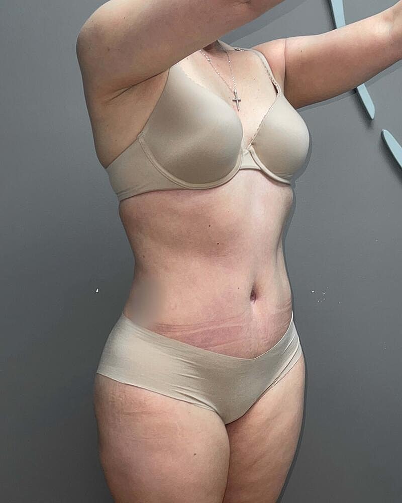 Tummy Tuck Before & After