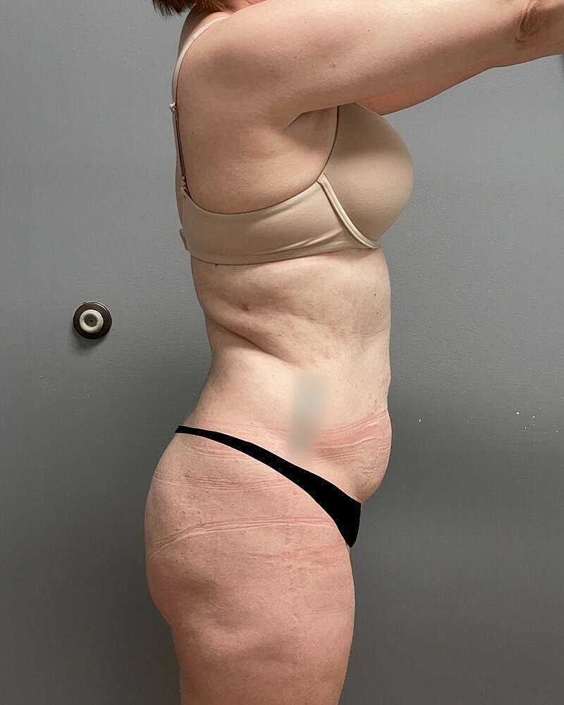 Tummy Tuck Before & After