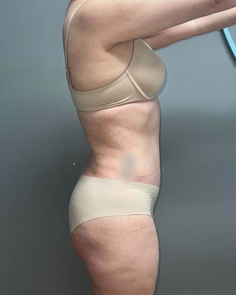 Tummy Tuck Before & After