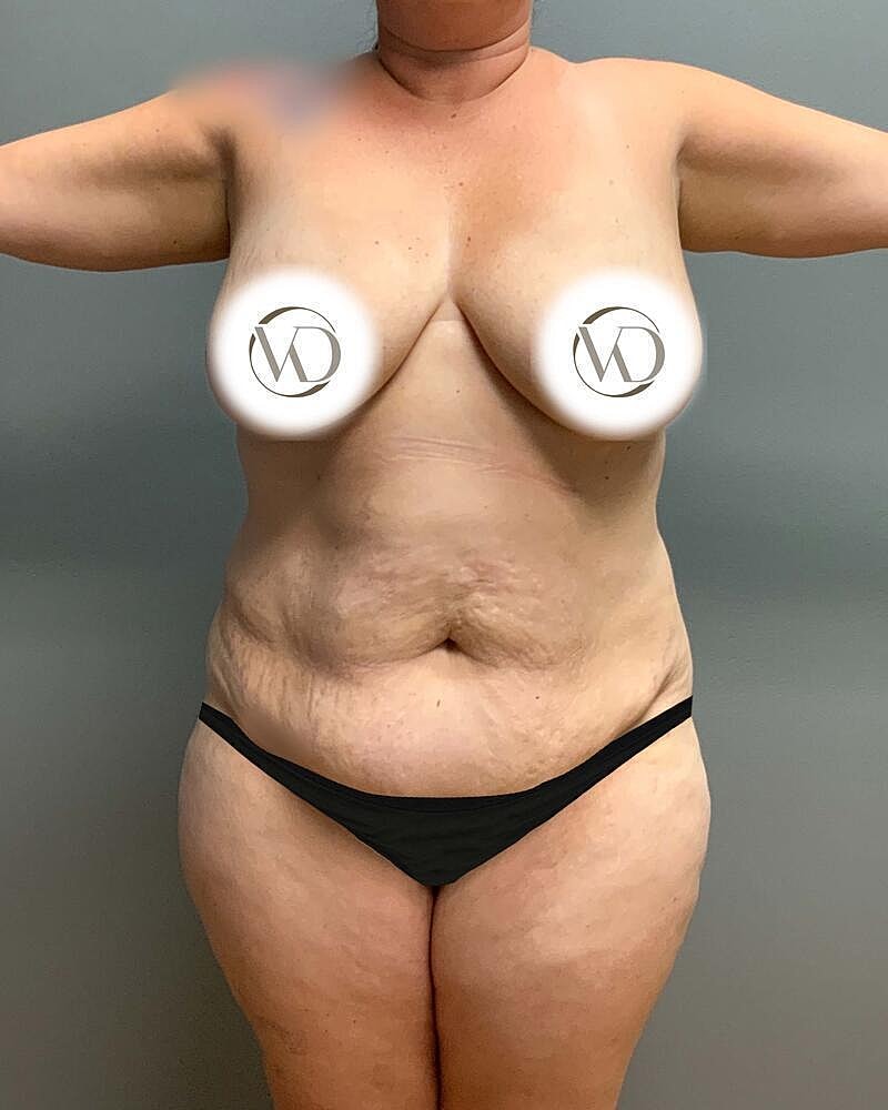 Tummy Tuck Before & After