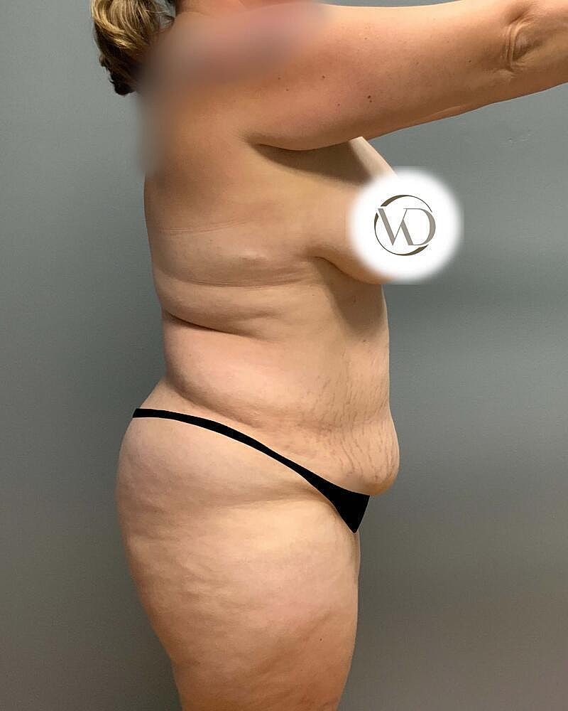 Tummy Tuck Before & After
