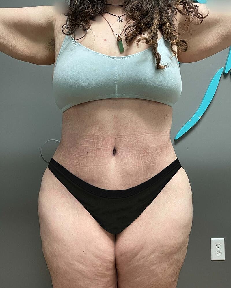 Tummy Tuck Before & After