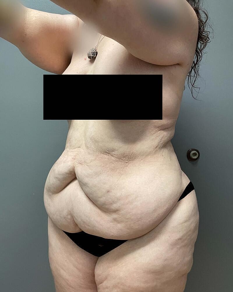 Tummy Tuck Before & After