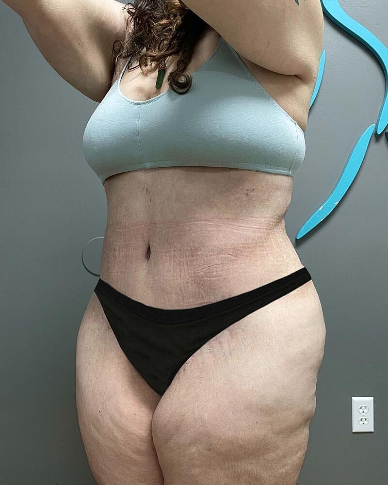 Tummy Tuck Before & After