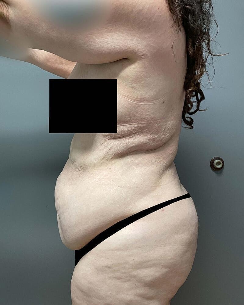 Tummy Tuck Before & After