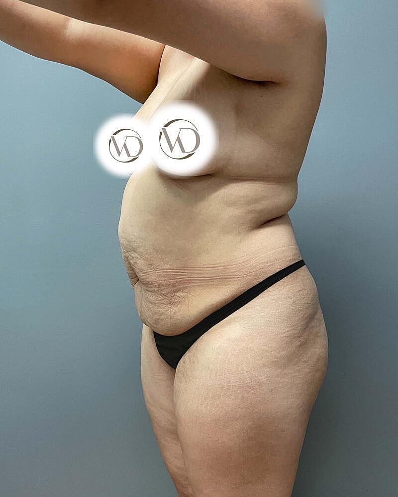 Tummy Tuck Before & After