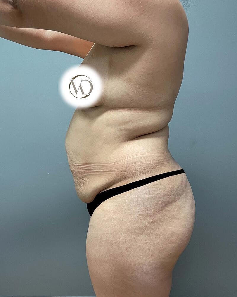 Tummy Tuck Before & After