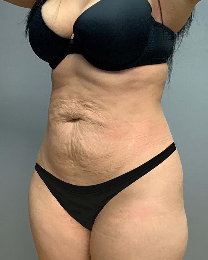Tummy Tuck Before & After