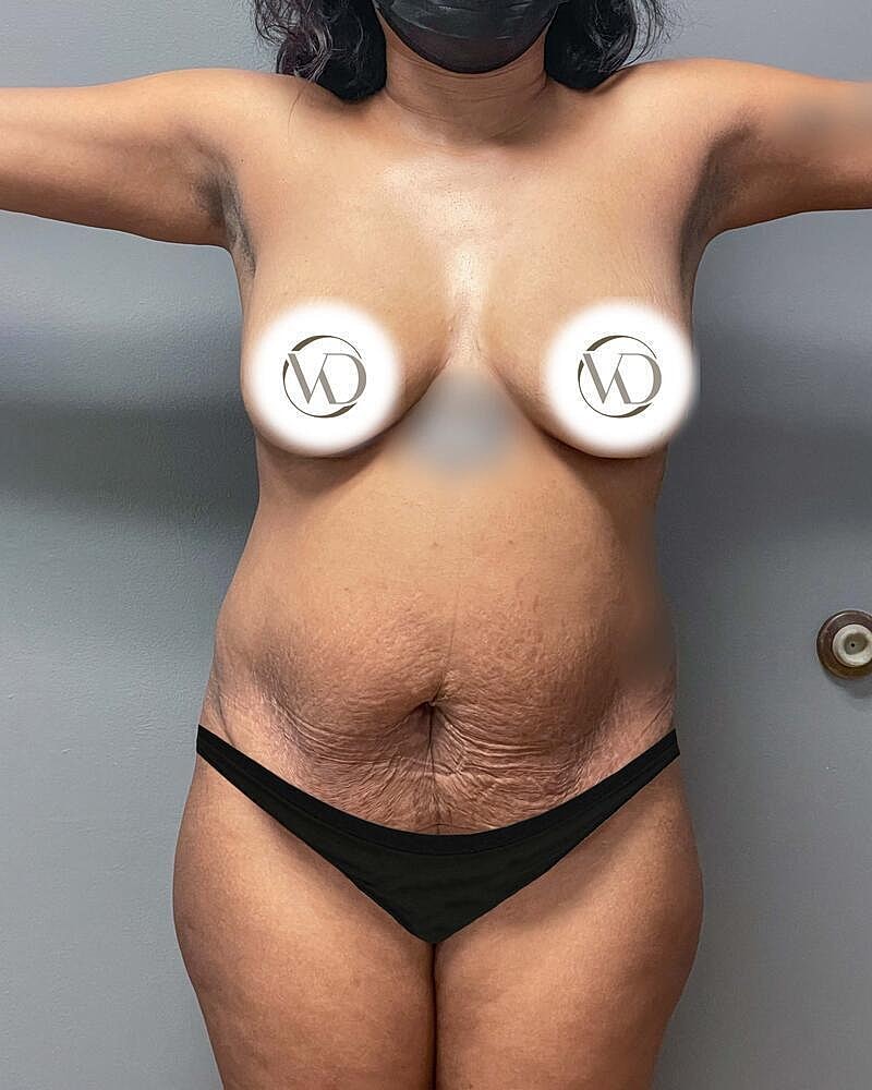 Tummy Tuck Before & After