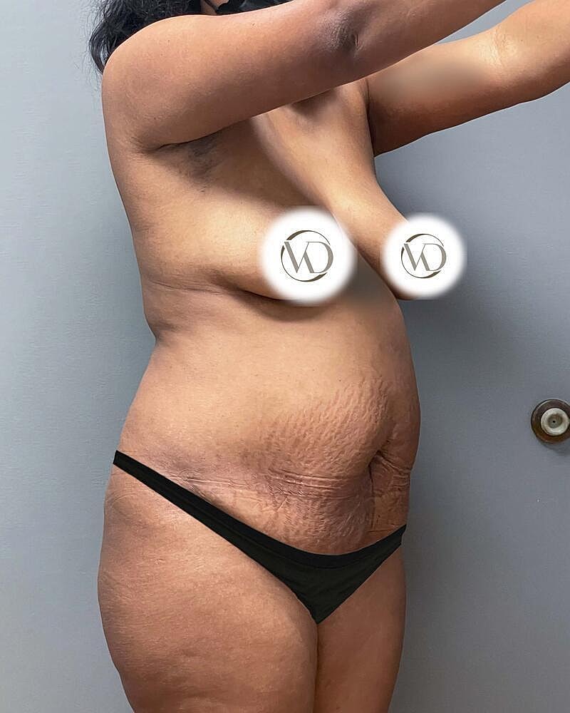 Tummy Tuck Before & After