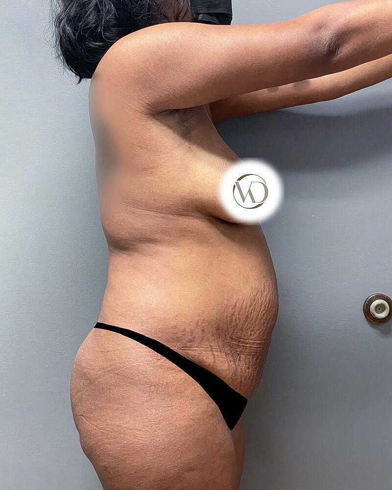 Tummy Tuck Before & After