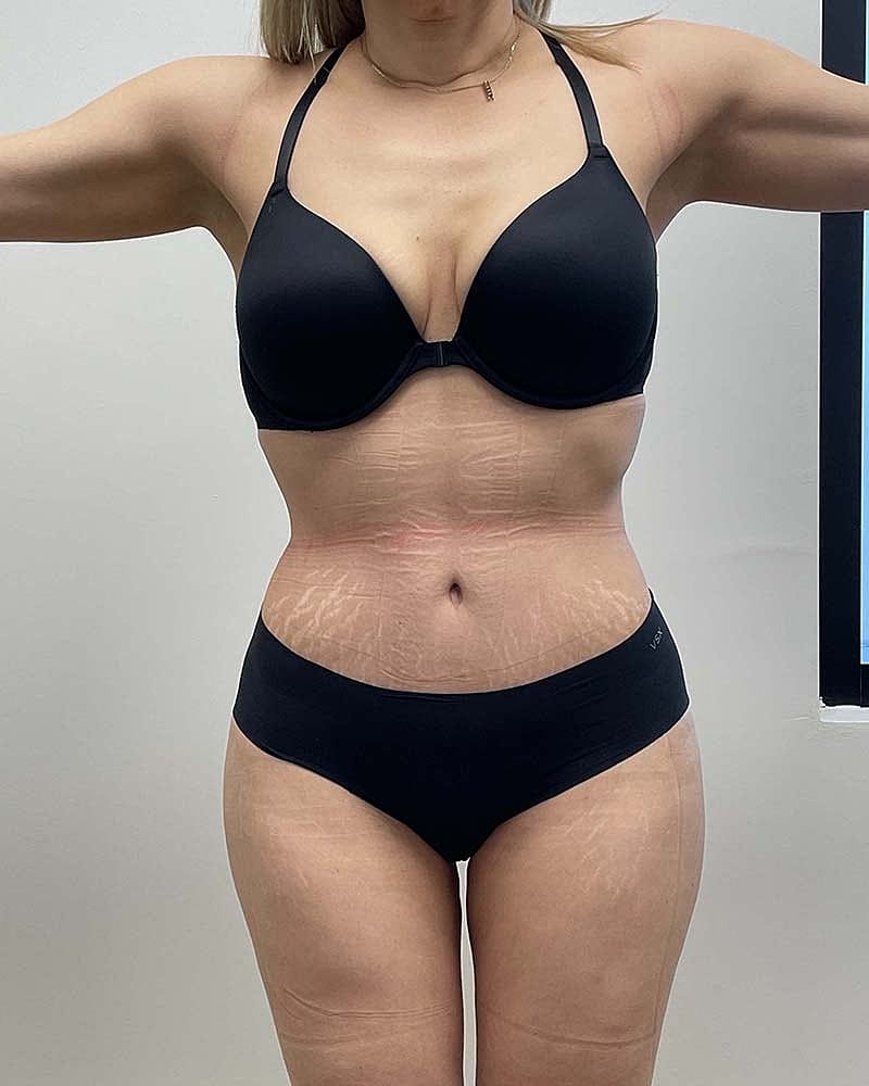 Tummy Tuck Before & After