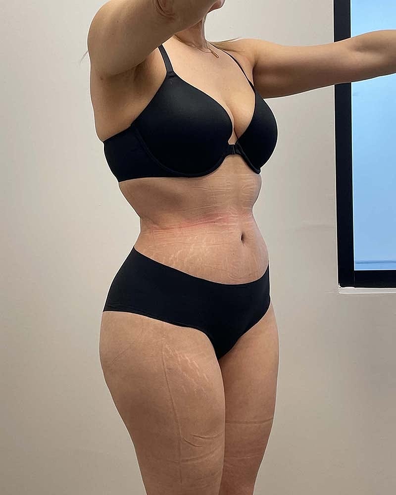Tummy Tuck Before & After