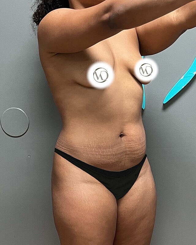 Tummy Tuck Before & After