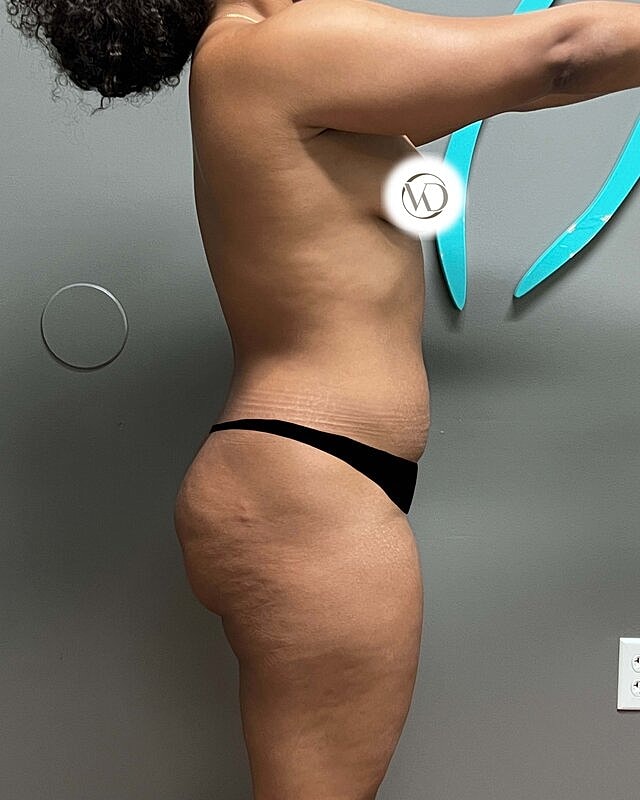 Tummy Tuck Before & After