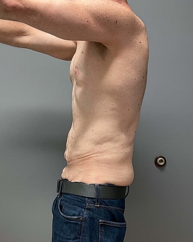 Tummy Tuck Before & After