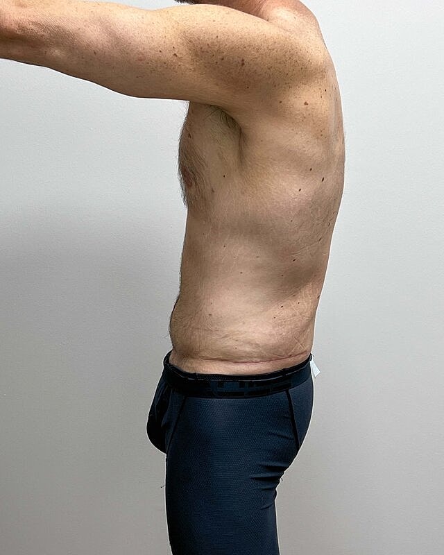 Tummy Tuck Before & After