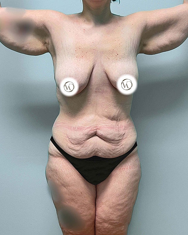 Tummy Tuck Before & After