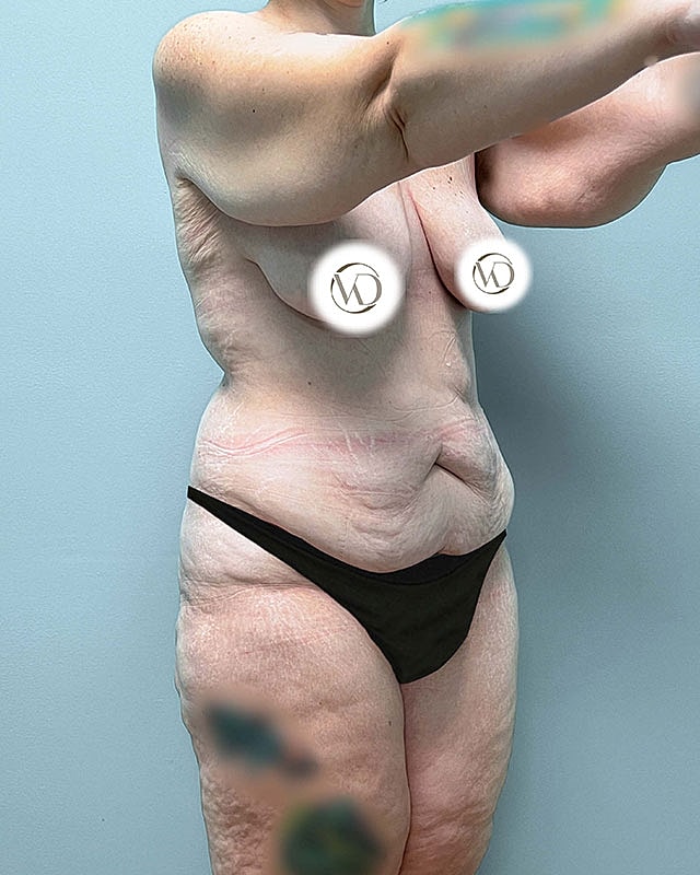Tummy Tuck Before & After