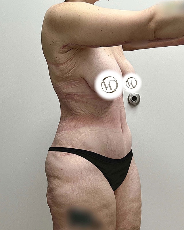 Tummy Tuck Before & After