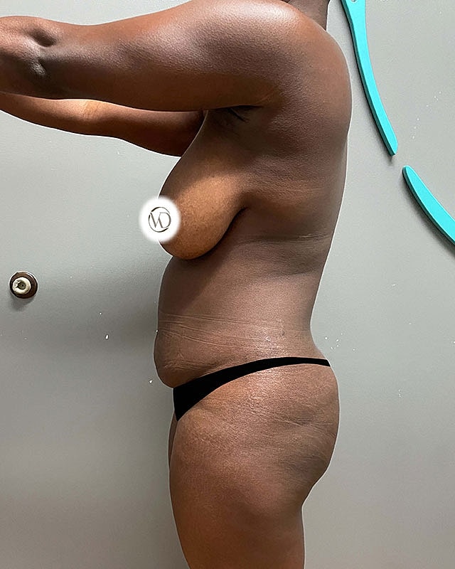 Tummy Tuck Before & After