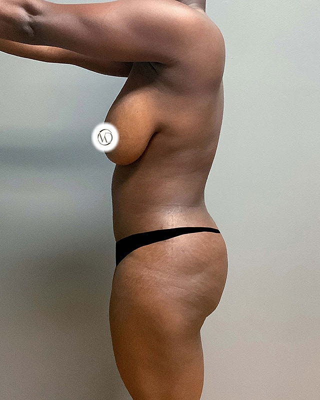 Tummy Tuck Before & After