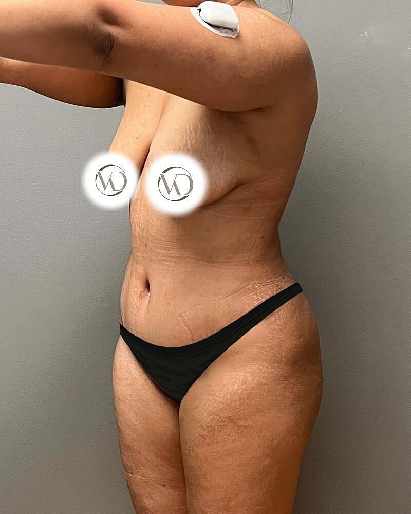 Tummy Tuck Before & After
