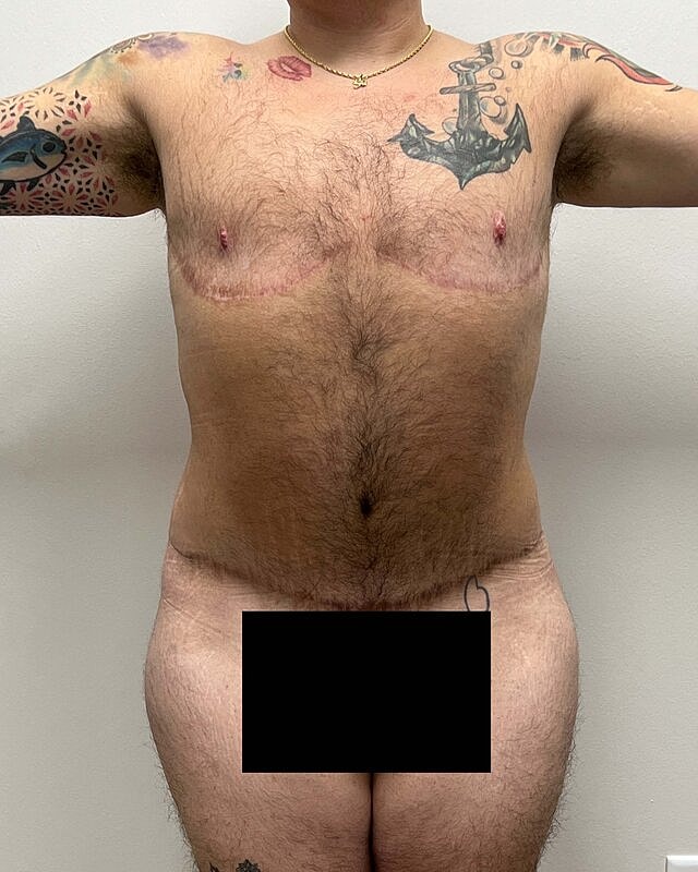 Tummy Tuck Before & After
