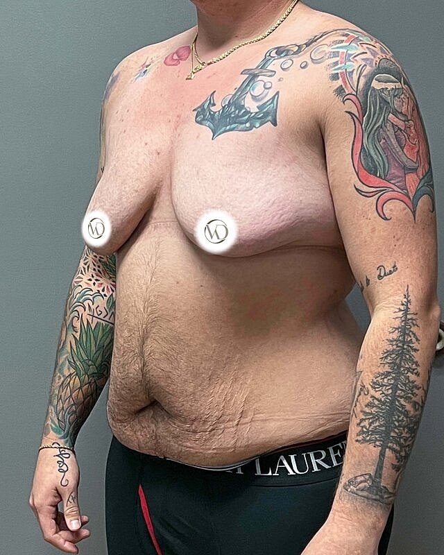 Tummy Tuck Before & After