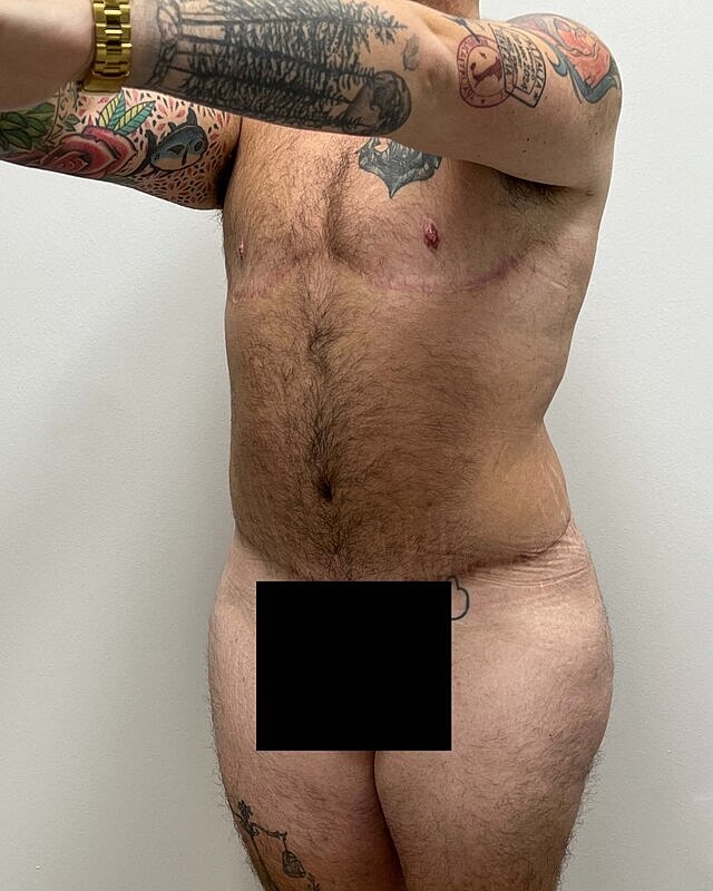Tummy Tuck Before & After