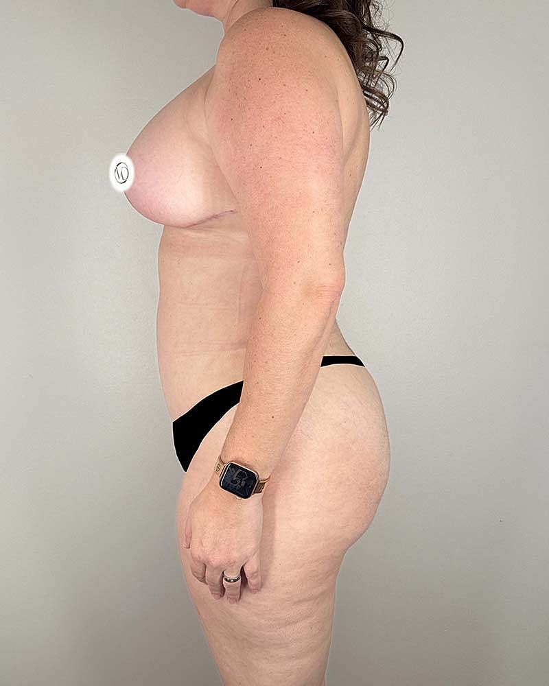 Tummy Tuck Before & After