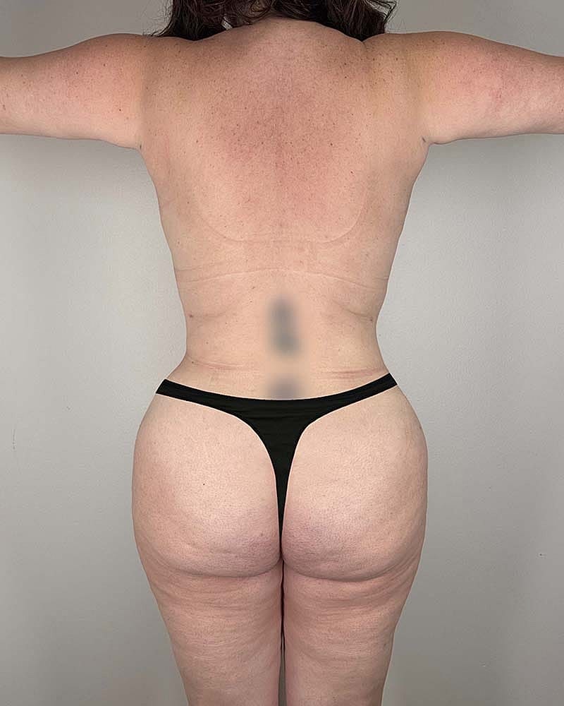 Tummy Tuck Before & After