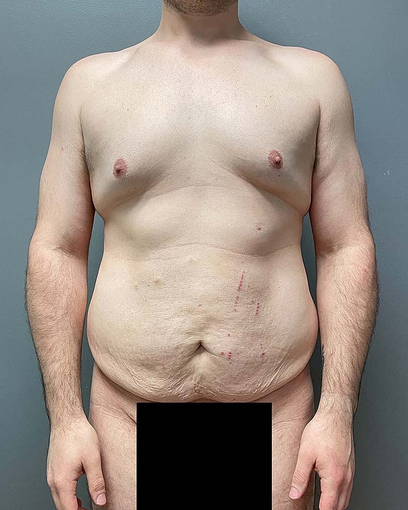 Tummy Tuck Before & After