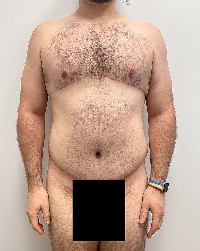Tummy Tuck Before & After