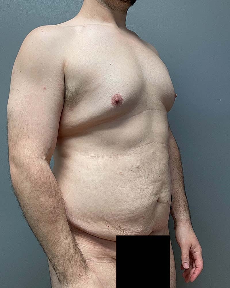 Tummy Tuck Before & After