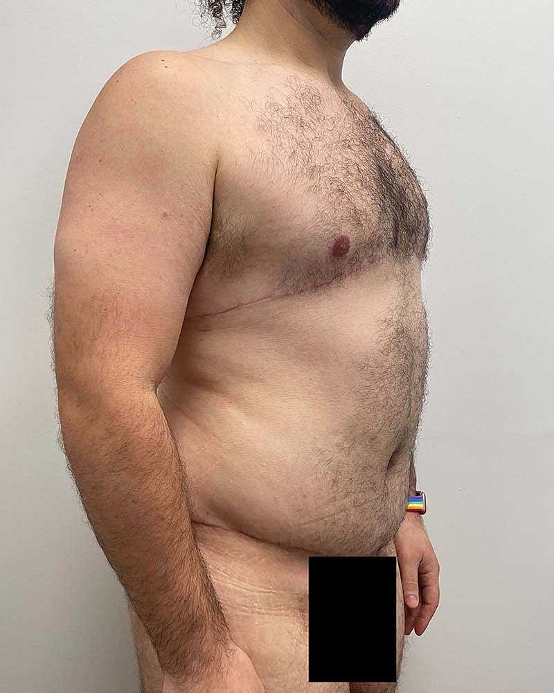 Tummy Tuck Before & After