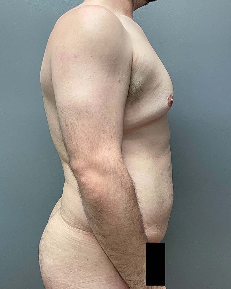 Tummy Tuck Before & After