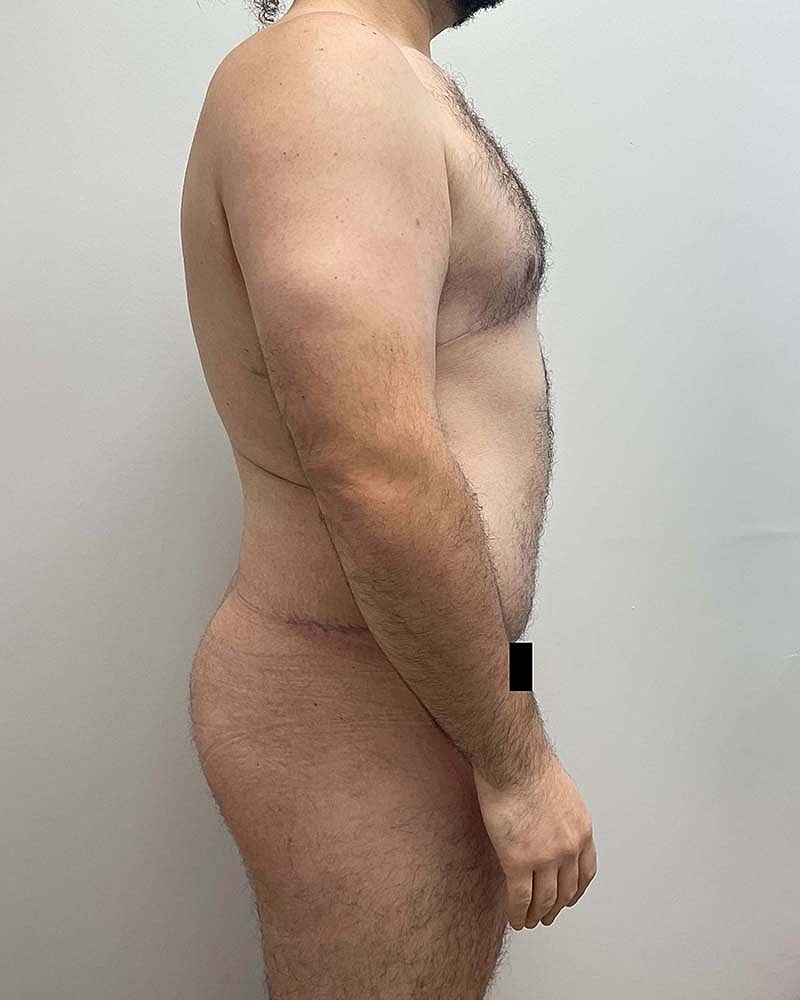 Tummy Tuck Before & After