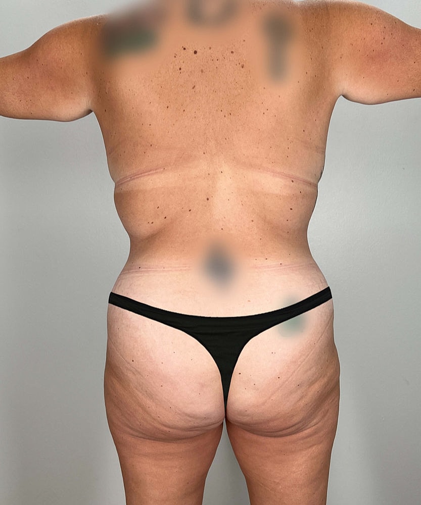 Tummy Tuck Before & After
