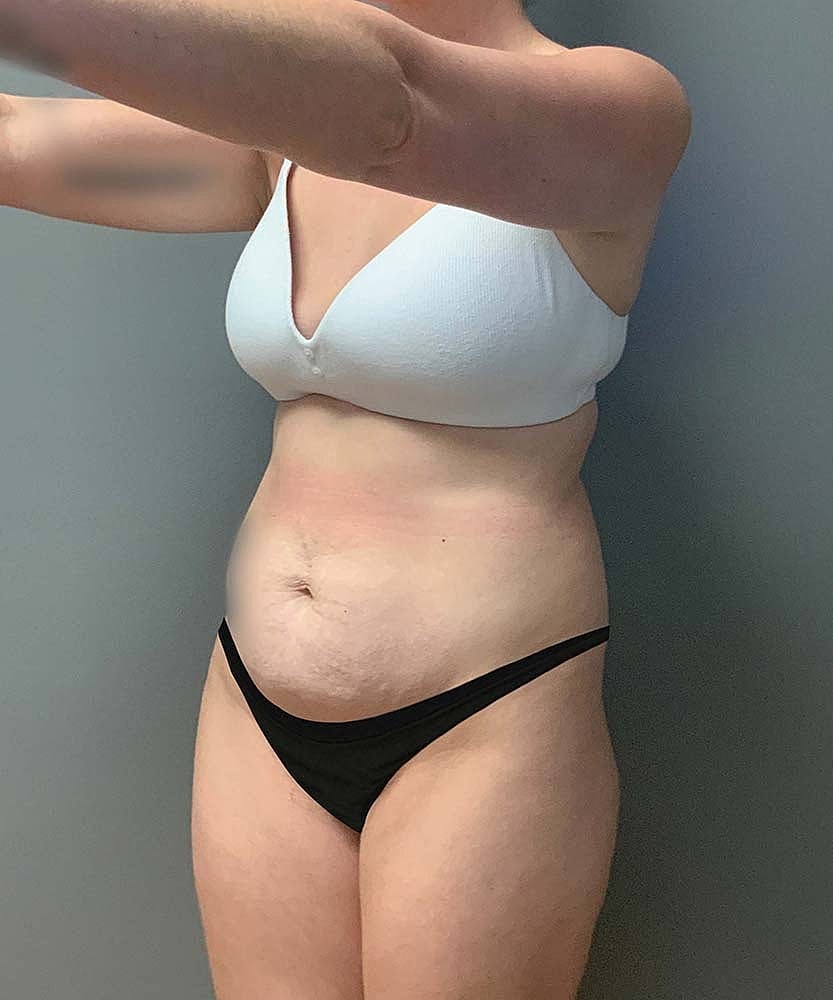 Tummy Tuck Before & After